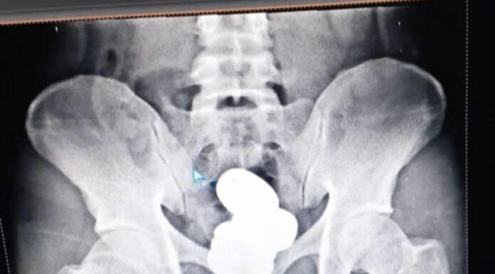 Cae contrabandista con un kilo de oro en el recto