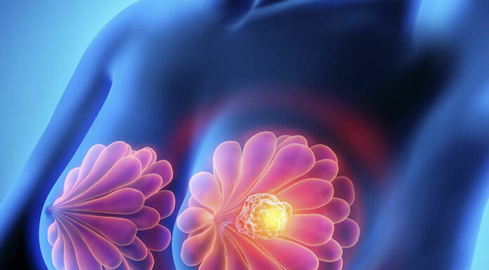 Por cáncer de mama fallecieron 338 mujeres en Puebla durante 2020