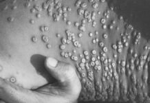 Bélgica, primer país en cuarentena por viruela del mono