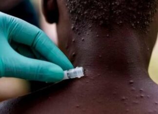 OMS eleva a 131 casos de viruela del mono, la mayoría son de España