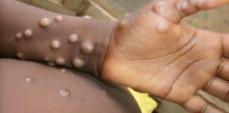 Lanza Bolivia alerta epidemiológica por viruela del mono La viruela del mono es una enfermedad poco común originaria de África.