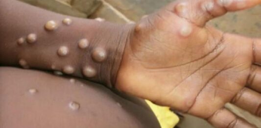 La viruela del mono es una enfermedad poco común originaria de África.