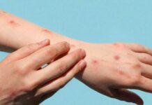 Suman 2 muertes por viruela del mono en España viruela