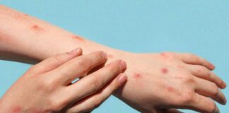 México reporta 147 contagios de viruela del mono  viruela