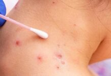 Suecia reporta primer caso de Viruela de mono fuera de África