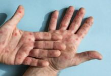 México suma 61 casos de Mpox en lo que va del 2024 colombia