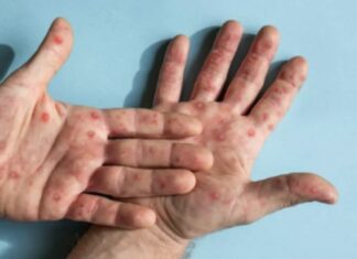 Colombia vacunará contra viruela del mono en septiembre colombia