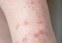 ¿Qué es la gripe del tomate? Detectan nuevo virus en India Gripe
