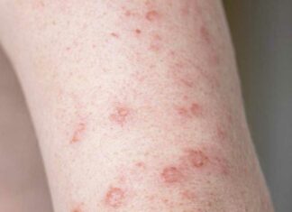 ¿Qué es la gripe del tomate? Detectan nuevo virus en India Gripe