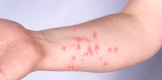 Viruela símica ha contagiado a 19 poblanos en el año viruela