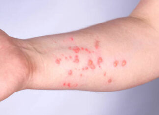 Viruela símica ha contagiado a 19 poblanos en el año viruela