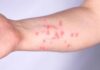 Confirman 49 casos de Mpox en México viruela