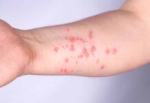 OMS declara emergencia sanitaria internacional por viruela del mono viruela