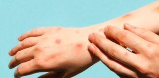 Portugal registra nuevo brote de viruela del mono viruela