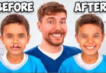 Mr. Beast financia cirugías para niños con labio leporino en Puebla Beast