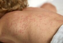 OMS pide respuesta rápida para brote de sarampión en Europa y Asia