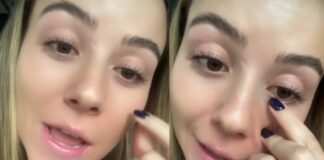 Joven descubre que vivió con un gusano en su ojo durante años