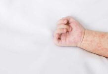 Secretaría de Salud emite aviso epidemiológico por sarampión sarampión