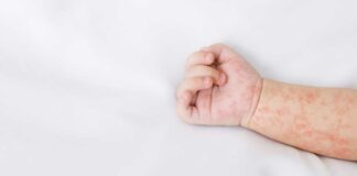 Secretaría de Salud emite aviso epidemiológico por sarampión sarampión