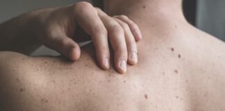 Cáncer de piel, el segundo tipo más común en México