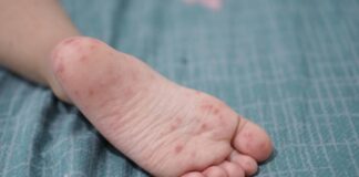 Confirman 18 casos de virus Coxsackie en escuelas de Puebla