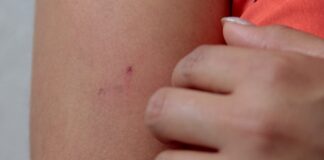 ISSSTEP se suma al combate del paludismo en Puebla