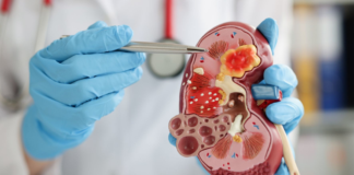 Salud alerta sobre prevención del cáncer renal