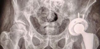 ISSSTEP realiza con éxito primera prótesis gratuita de cadera