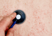 Confirman 28 casos de sarampión en Puebla