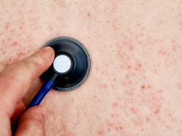 Suman 45 casos de sarampión en Puebla, la mayoría en adultos