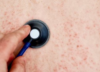 Suman 45 casos de sarampión en Puebla, la mayoría en adultos