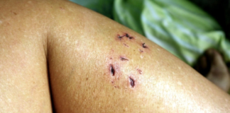 Joven de 17 años muere en Zacatecas por rabia humana