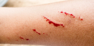 Confirman caso de rabia humana en joven de Zacatecas