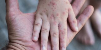 Registran 470 casos probables de virus coxsackie en Puebla