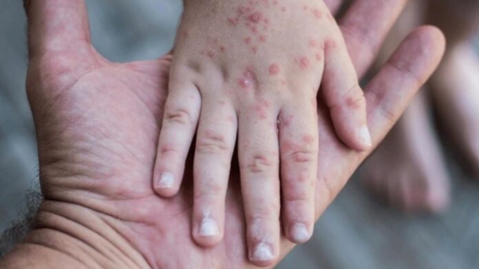 virus coxsackie