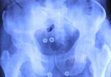 Inician cirugías de prótesis de cadera y rodilla para mayores de 60 años