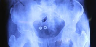 Inician cirugías de prótesis de cadera y rodilla para mayores de 60 años