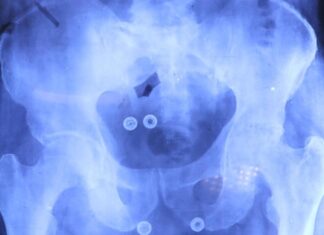 Inician cirugías de prótesis de cadera y rodilla para mayores de 60 años