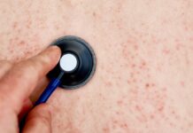 Disminuyen muertes por sarampión pero aumentan casos: OMS