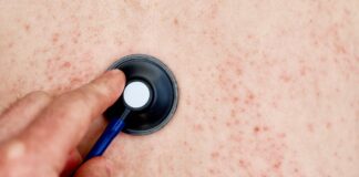 Disminuyen muertes por sarampión pero aumentan casos: OMS