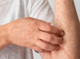 Suman 24 muertes y casi 6 mil casos de sarampión en México