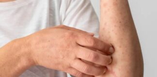 Suman 24 muertes y casi 6 mil casos de sarampión en México