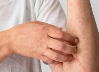 Suman 24 muertes y casi 6 mil casos de sarampión en México