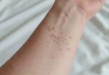 Sarampión se extiende a las 32 entidades de la República