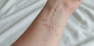 Sarampión se extiende a las 32 entidades de la República