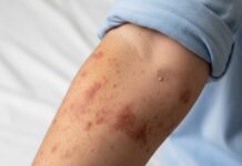 Salud confirma primer caso de sarampión en Puebla