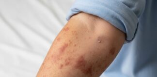 Salud confirma primer caso de sarampión en Puebla