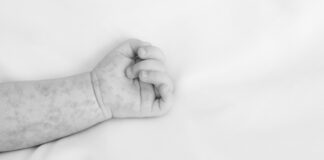 Fallece bebé por complicaciones de sarampión en Tlaxcala