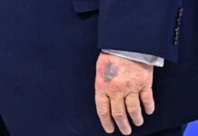 Trump atribuye nuevo moretón en mano a “golpe con una mesa”