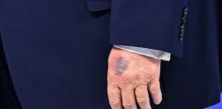Trump atribuye nuevo moretón en mano a “golpe con una mesa”